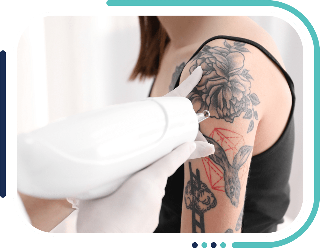 Tattoo Removal in Jalandhar