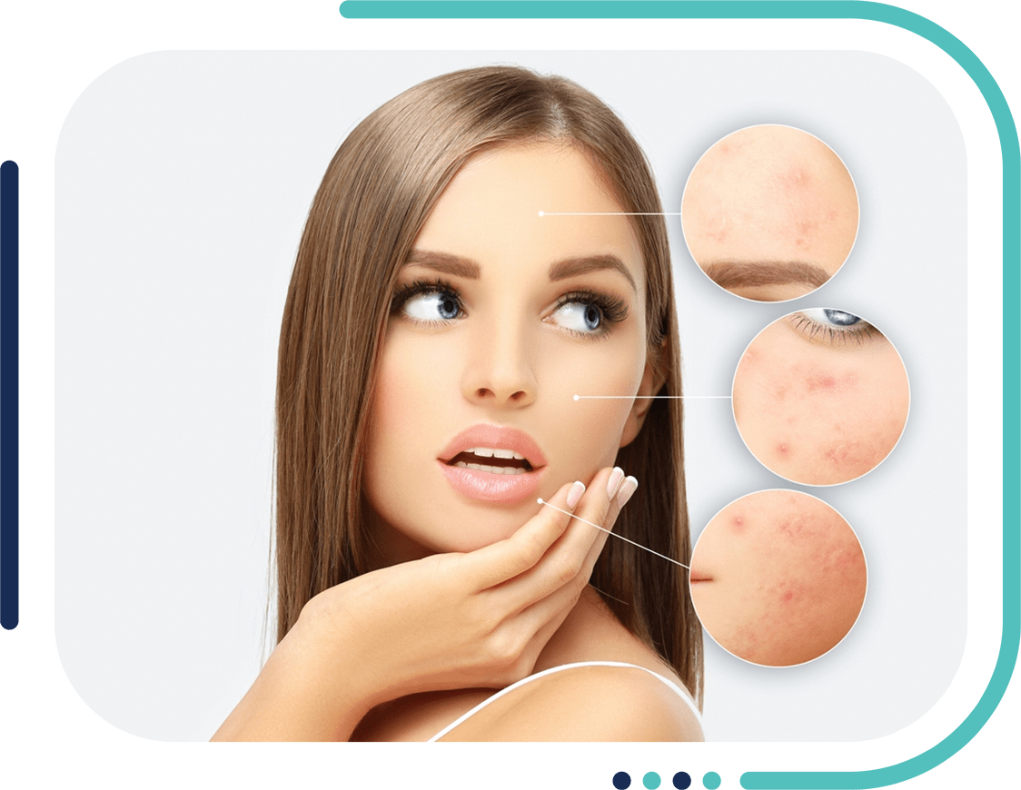 Acne Scar Treatment in Jalandhar