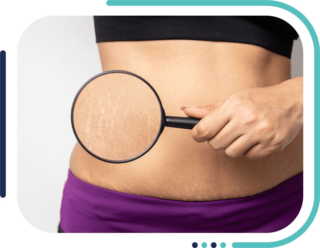 Stretch Marks Removal Treatment in Jalandhar