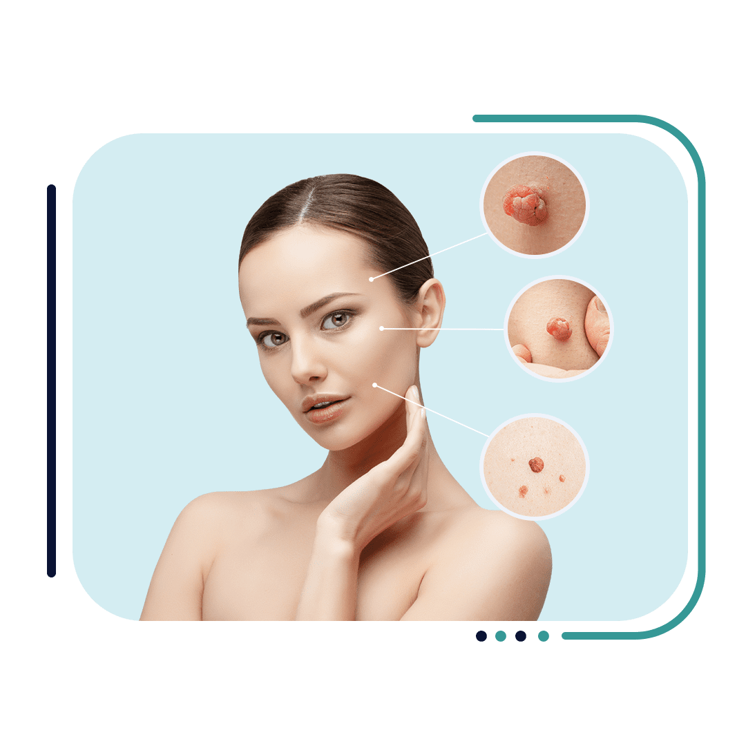 Best Skin Tag Removal Clinic Jalandhar