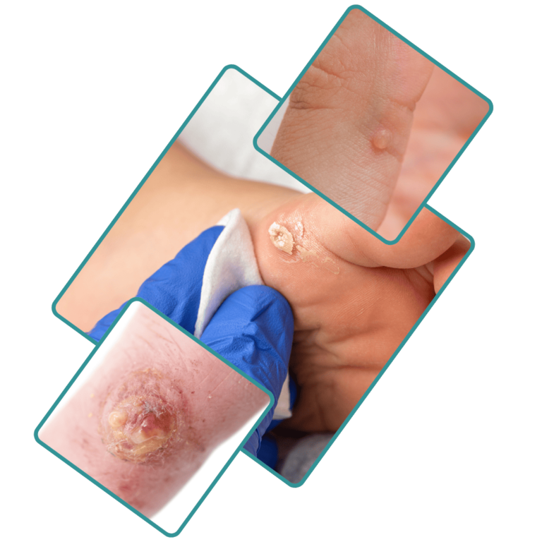 Best Wart Removal Treatment in Jalandhar