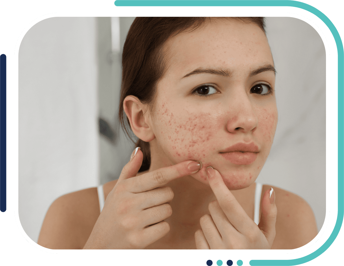 Acne Scar Treatment in Kapurthala