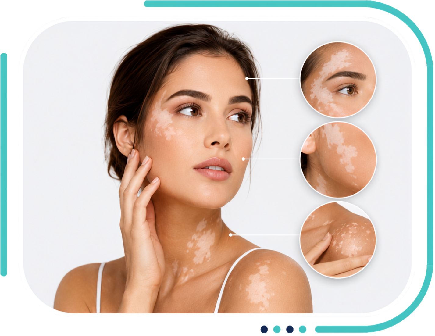 Vitiligo Treatment in Jalandhar