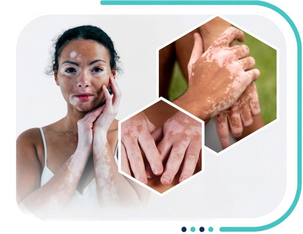 Vitiligo Treatment in Jalandhar