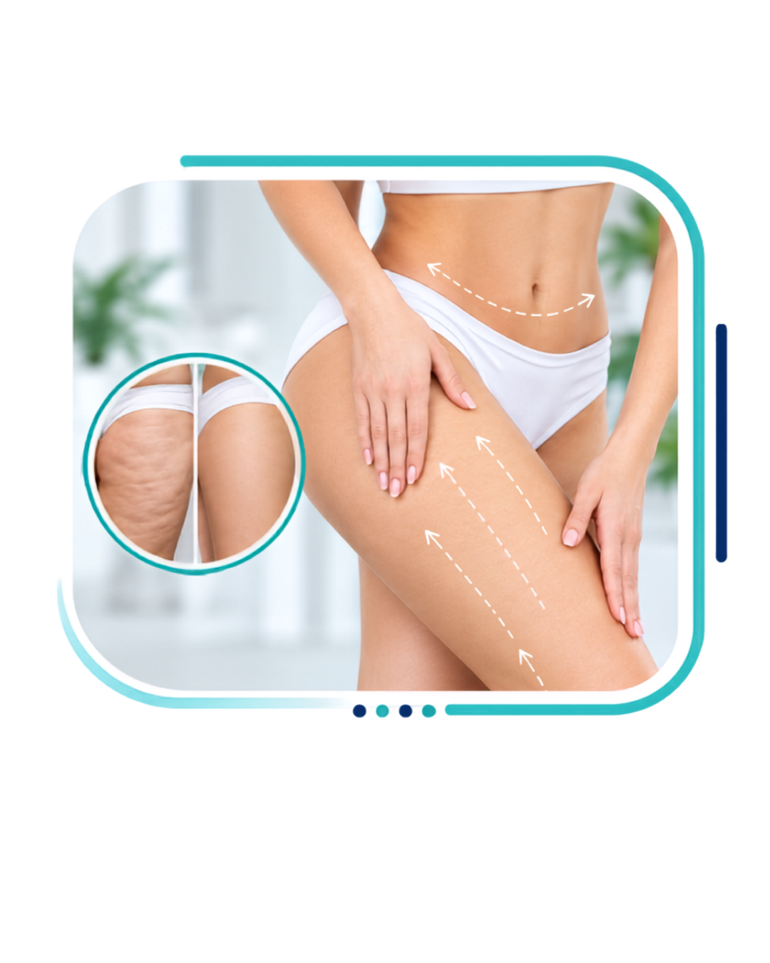 Cellulite Treatment in Kapurthala